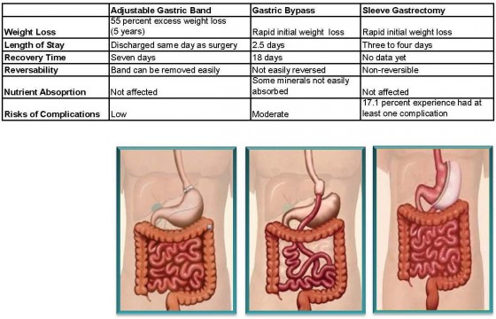 Weight Loss Surgeries Table