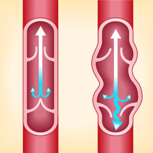 veins of the person under varices.the structure of a veins . the veins in the manifestation of the disease