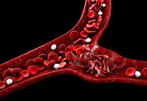 sickle cell disease in the blood stream