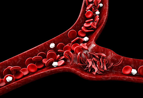 Helping kids with sickle cell disease live their healthiest lives