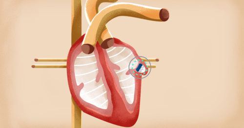 Watchman procedure reduces stroke risk in AFib patients