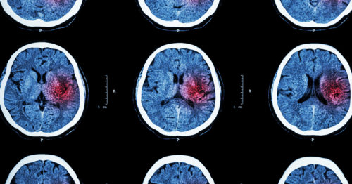 CT scans of a stroke sufferer's brain