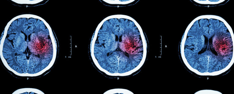 CT scans of a stroke sufferer's brain