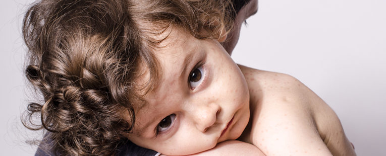 young boy with measles being comforted by father