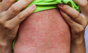 young boy with measles rash visible on arm
