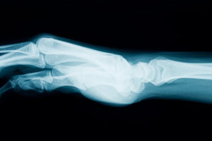 x-ray of a woman's hand and arm