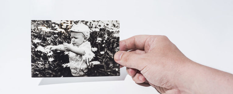 Congenital heart patient baby photo