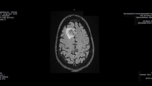 MRI image of Richard Giebelhausen's brain