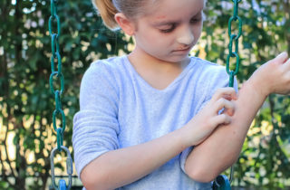 young girl outdoors with hives