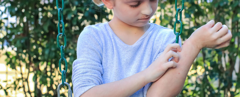 young girl outdoors with hives