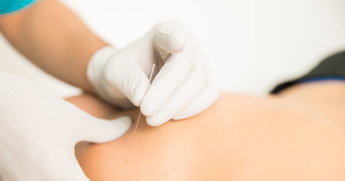 Physical therapy patient receiving dry needling therapy