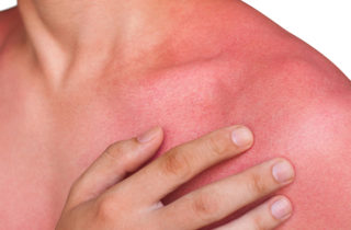 Man with sun rash on chest and arms.