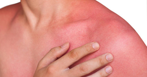 Man with sun rash on chest and arms.
