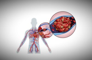 Inside of a person demonstrating aulmonary embolism.