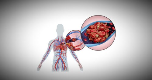 Inside of a person demonstrating aulmonary embolism.