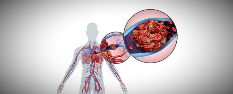 Inside of a person demonstrating aulmonary embolism.