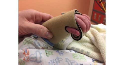 Child's hand in infant-sized splint