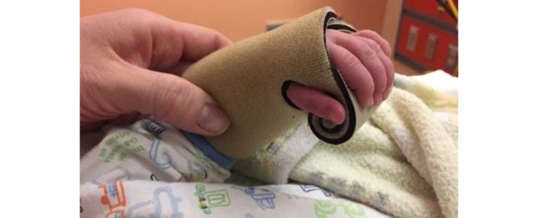 Child's hand in infant-sized splint