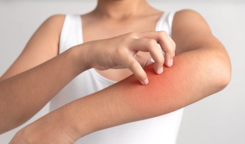Dealing with dry skin