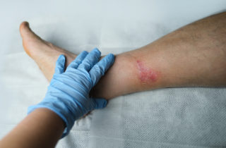 A doctor checking to see if a wound is healing or infected.