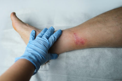 A doctor checking to see if a wound is healing or infected.