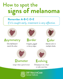 How to spot signs of Melanoma